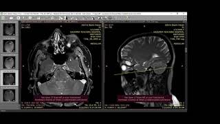 Orbital lymphangioma [upl. by Annav735]