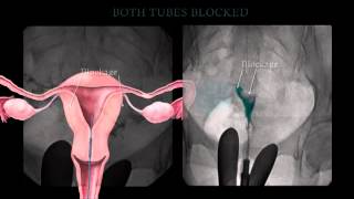 Fallopian Tube Recanalization and Selective Salpingography [upl. by Wetzell312]