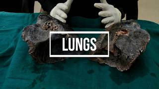 Lungs  gross anatomy [upl. by Thor]