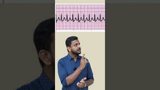 Supraventricular tachycardia ytshorts ecg fmge usmle plab mbbs [upl. by Etka]