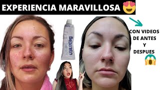 RETINOL ANTES Y DESPUES😱 TRETINOINA MI EXPERIENCIA DESPUES DE 6 MESES betarretin acido retinoico [upl. by Trueblood58]