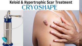 CRYOSHAPEfor the treatment of keloid scars [upl. by Latoye640]