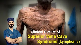 Superior Vena Cava Obstruction  Dr Tayyab Riaz Ch [upl. by Inig139]