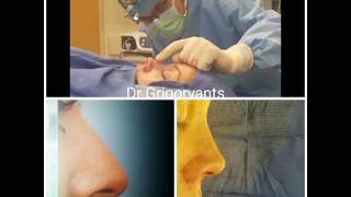 Nose reshaping using closed approach by Dr Vladimir Grigoryants [upl. by Orianna]