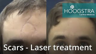 Scars  Laser treatment 20202 [upl. by Neeluj511]