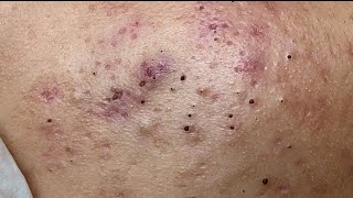 Blackheads on the young boys skin HoangMySpa80 [upl. by Cerell]