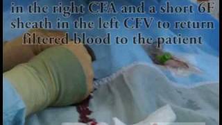 Carotid stenting with flow reversal cerebral protection [upl. by Ytram]