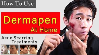 DERMAPEN SELF TREATMENT ON ACNE SCARS AT HOME [upl. by Vicki219]