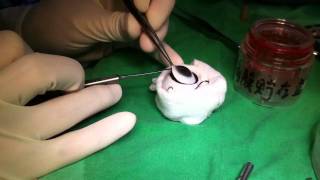 How to harvest cornea button [upl. by Eira]