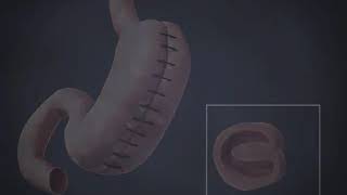 Gastric Plication Bariatric Surgery Animation 2020 Dr DavtyanBeverly Hills Glendale [upl. by Cherice575]