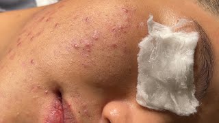 Blackheads amp Pimples Pore Removal New 2024  Acne Treatment With Bo Nguyễn Spa 027 [upl. by Akienahs]