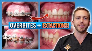 Braces Overbite Treatment BEFORE amp AFTER [upl. by Znerol]