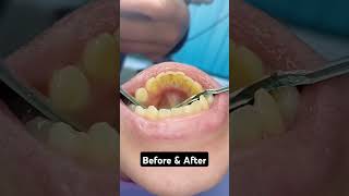 Tartar removal 👌 [upl. by Llednik]