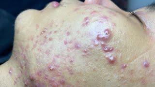 ACNE TREATMENT VU QUYNH MI Blackheads On Boy Face 2024 [upl. by Holt]