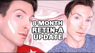 MY FIRST 8 MONTHS ON RETINA Before and After Results [upl. by Calhoun722]