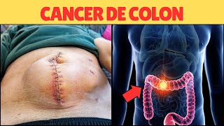 Sintomas Y Tratamiento Cancer De Colon [upl. by Eineg]