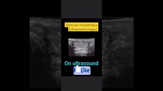 Testis microlithiasisultrasoundimagescalcificationsgrading of microlithiasisytshorts [upl. by Leanatan]