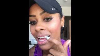 Adult Braces Vlog 6 Palate Expander Removal Dental Implants Snapchat Mariah Navit [upl. by Sousa990]