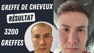 Résultat de la greffe de cheveux 3200 greffons l Avant et après l Greffe de cheveux en Turqui [upl. by Levan294]