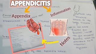 APPENDICITIS  BSC NURSING CAUSES PATHOPHYSIOLOGY SIGN AND SYMPTOMS MANAGEMENT [upl. by Itsim286]