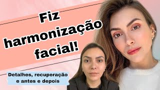 CONTEI TUDO SOBRE MINHA HARMONIZAÇÃO FACIAL [upl. by Sonnnie]