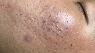 ACNE TREATMENT VU QUYNH MI  Blackheads On Boy Face 2024FULL [upl. by Cordle782]