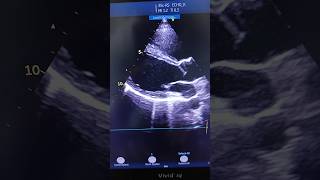 2D Echocardiographystatusyoutubeshortsytyoutube [upl. by Coreen885]