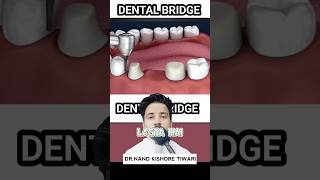 Dental BRIDGE procedure  Dental BRIDGE kaise BANTA HAI ❓shorts dental [upl. by Fanchie291]