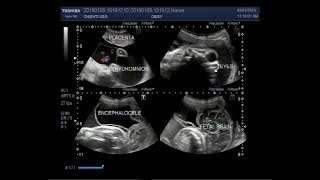 Ultrasound Video showing Anencephaly Encephalocele and Polyhdromnios [upl. by Margaretha]