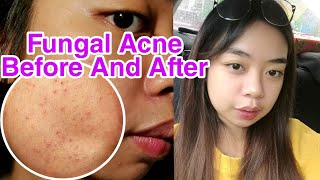 FUNGAL ACNE  Before And After Treatment [upl. by Bobbee]