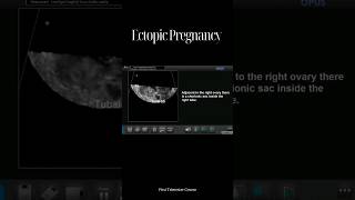 Ectopic Pregnancy [upl. by Eppie6]