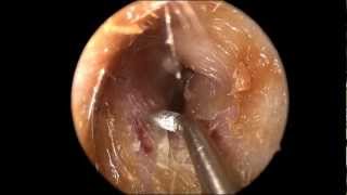 Ear Wax Cerumen Removal in HD [upl. by Andromede]