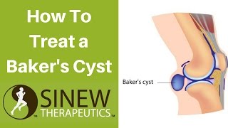 How To Treat a Baker’s Cyst and Speed Recovery [upl. by Ezaria]