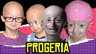 Weird Health News Progeria [upl. by Oicul]