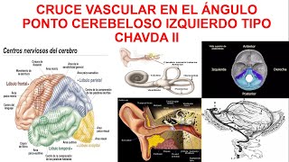 CRUCE VASCULAR EN EL ÁNGULO PONTO CEREBELOSO IZQUIERDO TIPO CHAVDA II [upl. by Zacek]