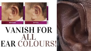 The Solution for Every Ear Colour Vanish Hide my Hearing Aid Review [upl. by Nylireg]