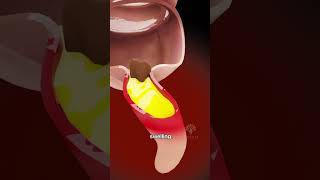 How Appendicitis Happens  appendix symptoms shorts  creativelearning3d [upl. by Jocelyne792]