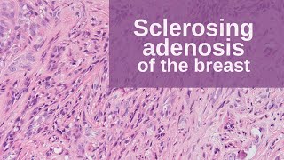 Sclerosing Adenosis of the Breast  Pathology mini tutorial [upl. by Ainirtac]