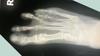 What the Heck Is It  Short Toe Syndrome [upl. by Boucher]