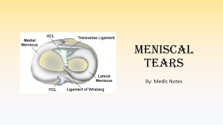 Meniscal tears  classification signs and symptoms MRI findings treatment surgery complications [upl. by Woodberry]