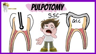 PEDIATRIC DENTISTRY  PULPOTOMY  Types Indications Procedure [upl. by Tilly]