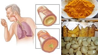 Natural Remedies for Chest Congestion Relief [upl. by Jessalin]