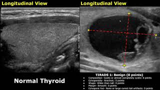 ACR TIRADS Classification Of Thyroid Nodules Ultrasound  Thyroid Imaging Reporting and Data System [upl. by Scarlet392]