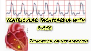 ventricular tachycardia with pulse [upl. by Aihsem240]