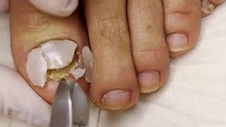 Fungal Nail with Dried Abscess 🦶 Ingrown Nail Treatment 🦶 Thick Fungal Toenail [upl. by Reinhart]