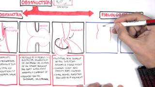 Bowel Obstruction  Causes and Pathophysiology [upl. by Harmonie336]