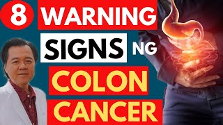 8 Warning Signs ng Colon Cancer  Tips by Doc Willie Ong Internist and Cardiologist1081b [upl. by Anasxor857]