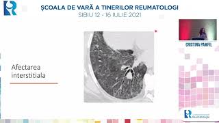 Afectarea pulmonara in vasculitele sistemice  Cristina Pamfil [upl. by Sihtam564]