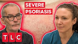 Dr Emma Treats a Severe Case Of Psoriasis  The Bad Skin Clinic [upl. by Brander]