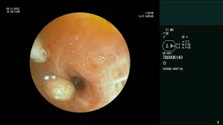 Endobronchial Carcinoid  Tumor debulking  Electrosurgical snaring  Cryoextraction [upl. by Berty95]